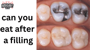 Close-up of dental fillings, showing both silver and tooth-colored fillings in molars. The image highlights the difference in appearance between traditional amalgam fillings and composite fillings, accompanied by the question 'Can you eat after a filling?